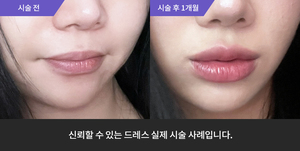 입술필러
