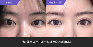 자연유착 + 눈매교정재수술