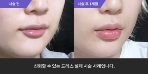 입술필러 + 티타늄