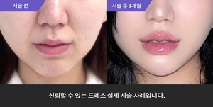 암살주사 + 울쎄라