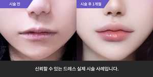 입술필러