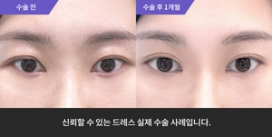 자연유착재수술 + 윗트임