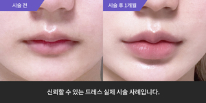 입술필러