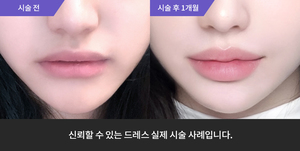입술필러