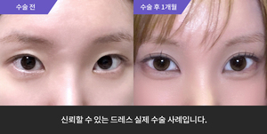 자연유착재수술 + 앞트임 + 윗트임