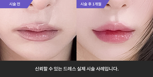 입술필러
