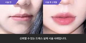 암살주사 + 입술필러