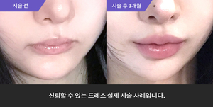 입술필러