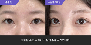 자연유착재수술 + 눈매교정재수술 + 뒷트임 + 밑트임
