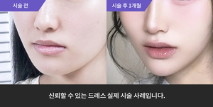 코필러 + 티타늄