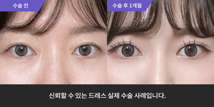 자연유착재수술 + 윗트임