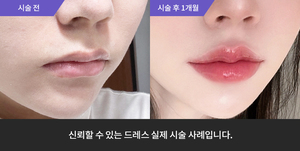 입술필러