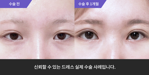 자연유착 + 눈매교정 + 앞트임 + 눈밑지방재배치