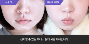 풀페이스 필러 + 티타늄