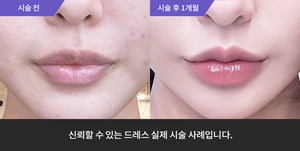 입술필러