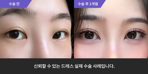 자연유착재수술 + 눈매교정 + 앞트임 +윗트임
