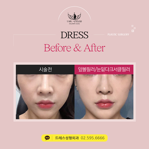 앞볼필러+눈밑다크서클필러