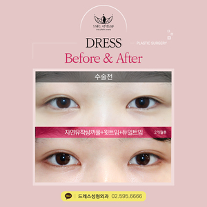 자연유착쌍꺼풀+윗트임+듀얼트임