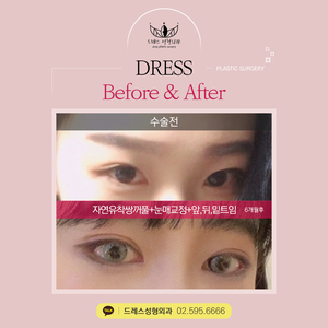 자연유착쌍꺼풀+눈매교정+앞트임,뒤트임,밑트임