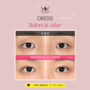 자연유착쌍꺼풀(눈재수술)+눈매교정