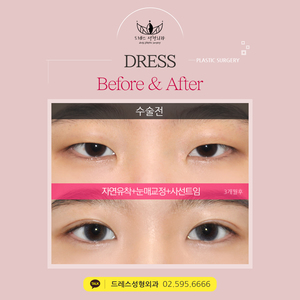 자연유착쌍꺼풀+눈매교정+사선트임