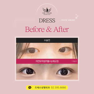 자연유착쌍꺼풀+눈매교정