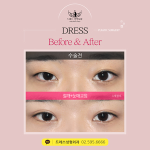 절개쌍꺼풀+눈매교정