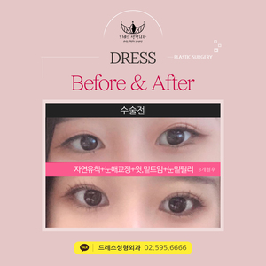 자연유착쌍꺼풀+눈매교정+윗트임+밑트임+눈밑필러