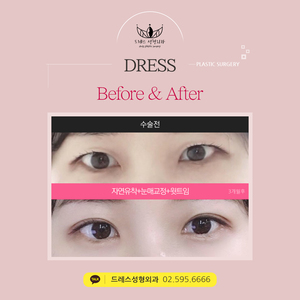 자연유착쌍꺼풀+눈매교정+윗트임