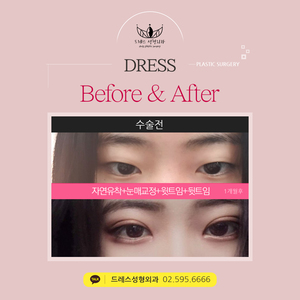 자연유착쌍꺼풀+눈매교정+윗트임+뒷트임