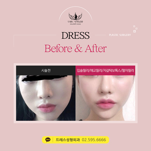 입술필러+애교필러+자갈턱보톡스+팔자필러