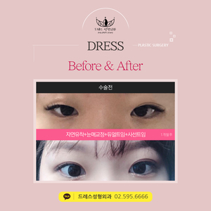 자연유착쌍꺼풀+눈매교정+듀얼트임+사선트임
