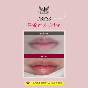 입술필러