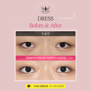 자연유착쌍꺼풀+눈매교정+지방제거+사선트임