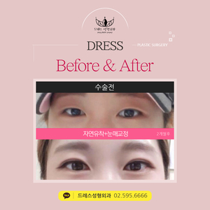 자연유착쌍꺼풀+눈매교정