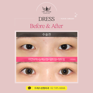 자연유착쌍꺼풀+눈매교정+앞트임+뒷트임