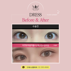 자연유착쌍꺼풀+눈매교정+앞트임