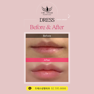 입술필러