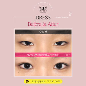 자연유착쌍꺼풀+눈매교정+윗트임