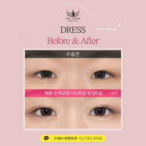 자연유착쌍꺼풀+눈매교정+사선트임+듀얼트임