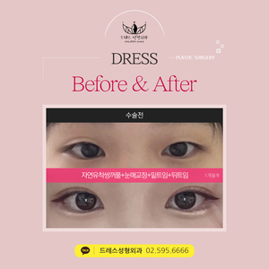 자연유착쌍꺼풀+눈매교정+밑트임+뒤트임