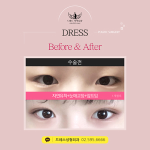 자연유착쌍꺼풀+눈매교정+앞트임