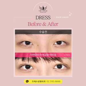 자연유착쌍꺼풀+눈매교정+윗트임