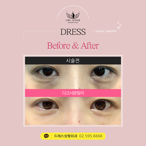 다크서클필러