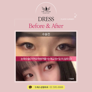 눈재수술(자연유착쌍꺼풀+눈매교정+앞트임,뒤트임,밑트임)