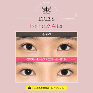 절개재수술+눈매교정재수술+아웃라인을 인아웃으로 줄이기