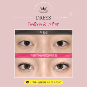 자연유착쌍꺼풀+눈매교정+윗트임