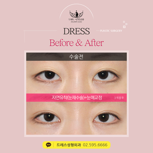 눈재수술(자연유착쌍꺼풀)+눈매교정
