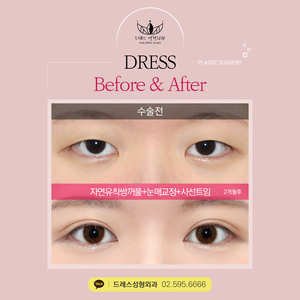 자연유착쌍꺼풀+눈매교정+사선트임
